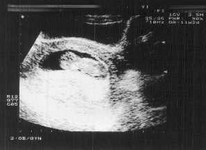 Ultrasound at 10 weeks